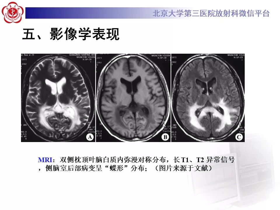 影像PPT - 【PPT】肾上腺脑白质营养不良（ALD）影像诊断-20