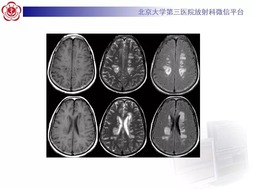 影像PPT - 【PPT】肾上腺脑白质营养不良（ALD）影像诊断-26