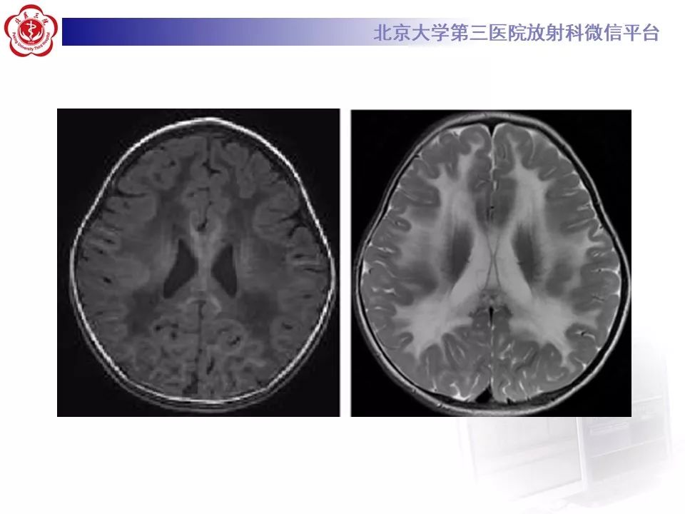 影像PPT - 【PPT】肾上腺脑白质营养不良（ALD）影像诊断-28