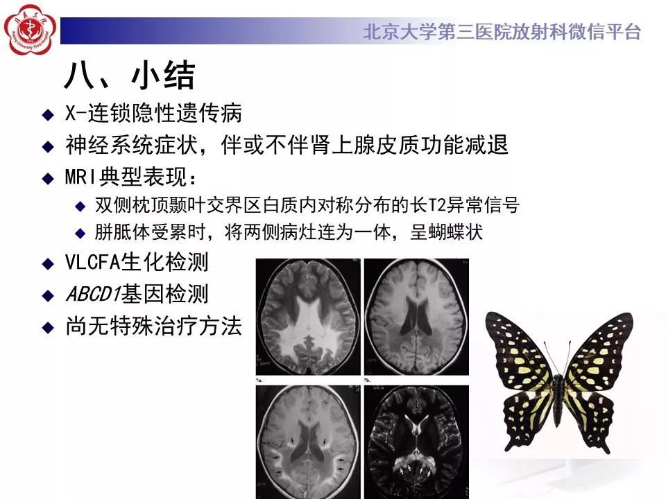 影像PPT - 【PPT】肾上腺脑白质营养不良（ALD）影像诊断-30