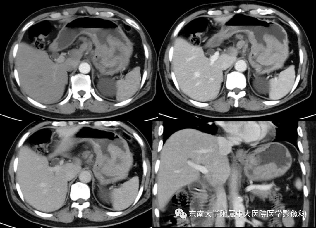 影像PPT - 【病例】胃肝样腺癌伴肝转移2例影像诊断-5