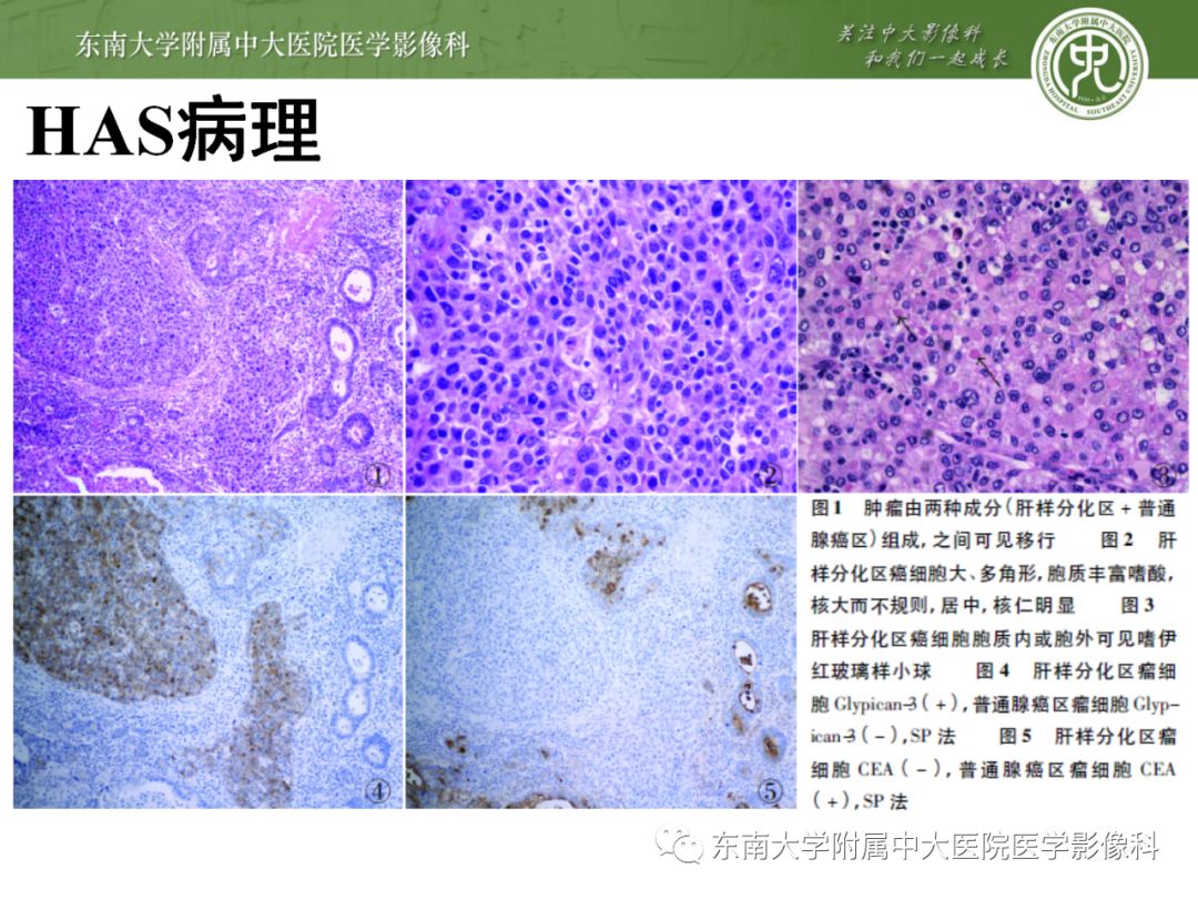 影像PPT - 【病例】胃肝样腺癌伴肝转移2例影像诊断-14