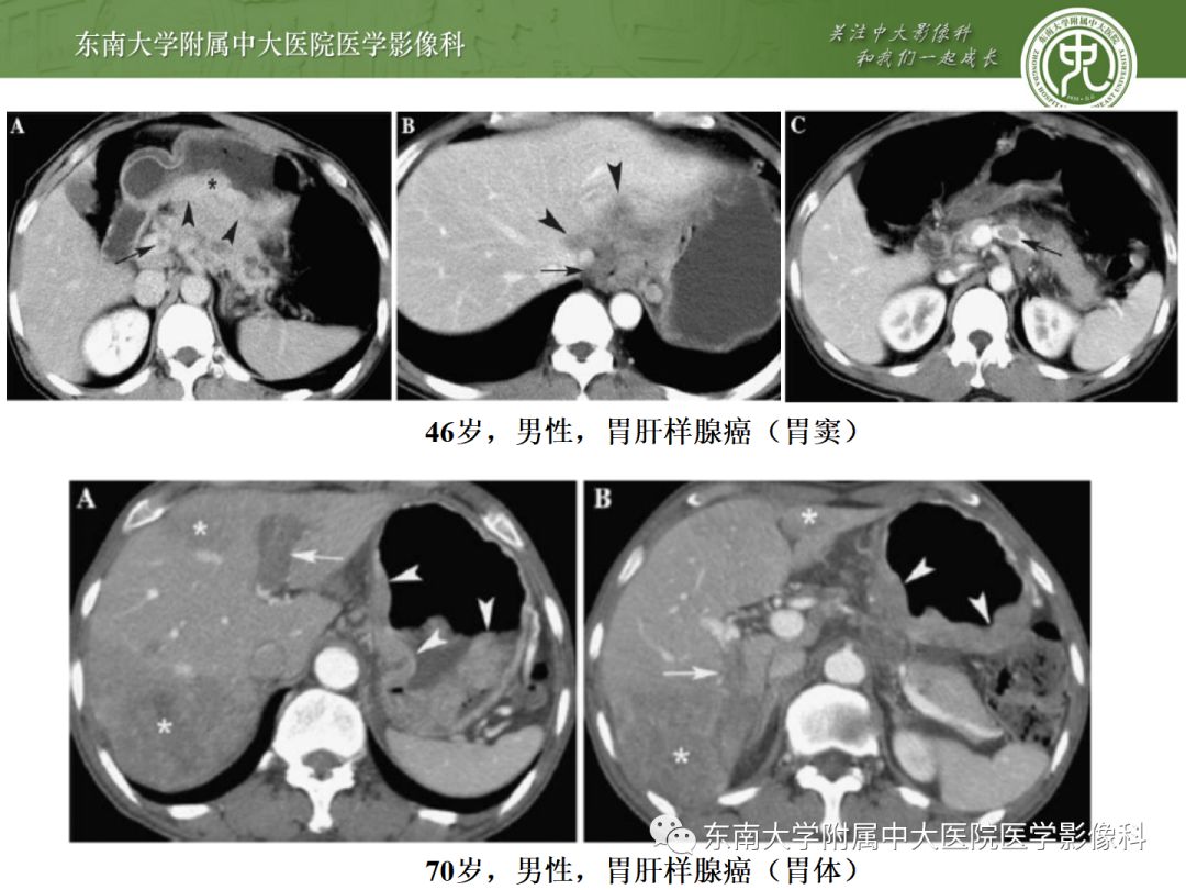 影像PPT - 【病例】胃肝样腺癌伴肝转移2例影像诊断-17