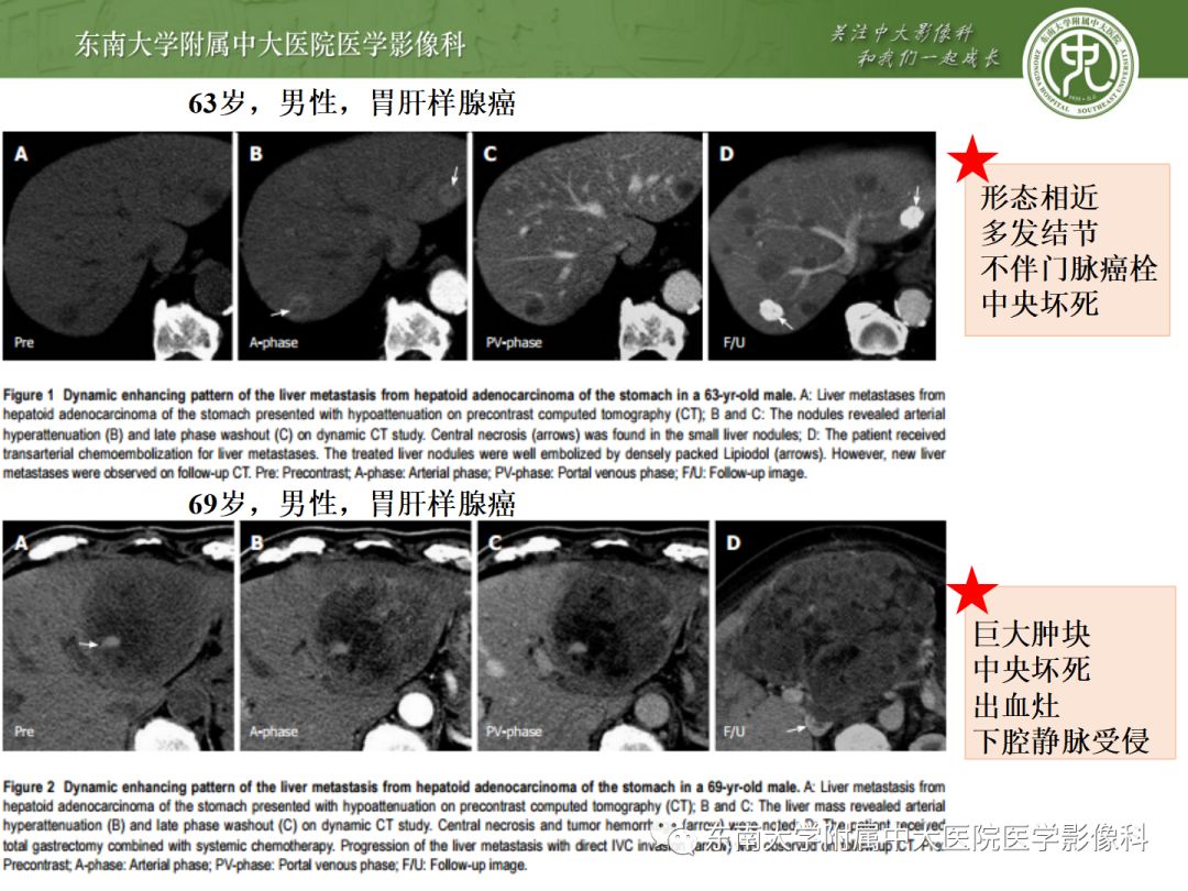 影像PPT - 【病例】胃肝样腺癌伴肝转移2例影像诊断-18