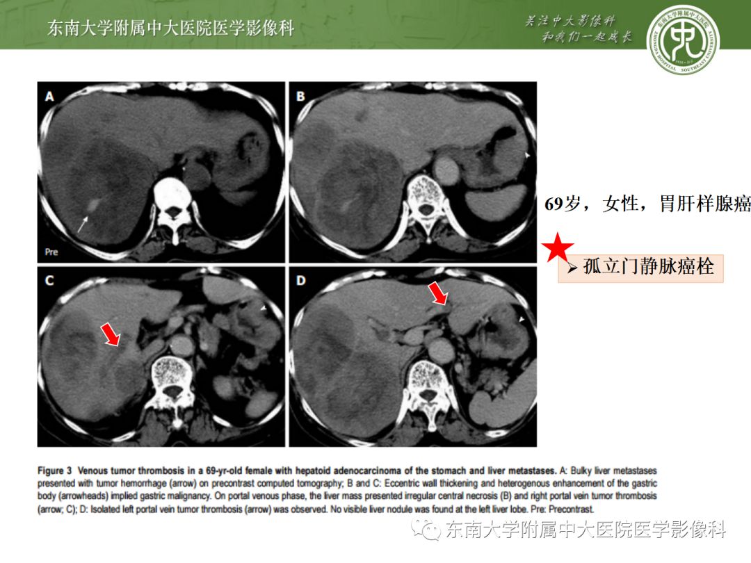 影像PPT - 【病例】胃肝样腺癌伴肝转移2例影像诊断-19