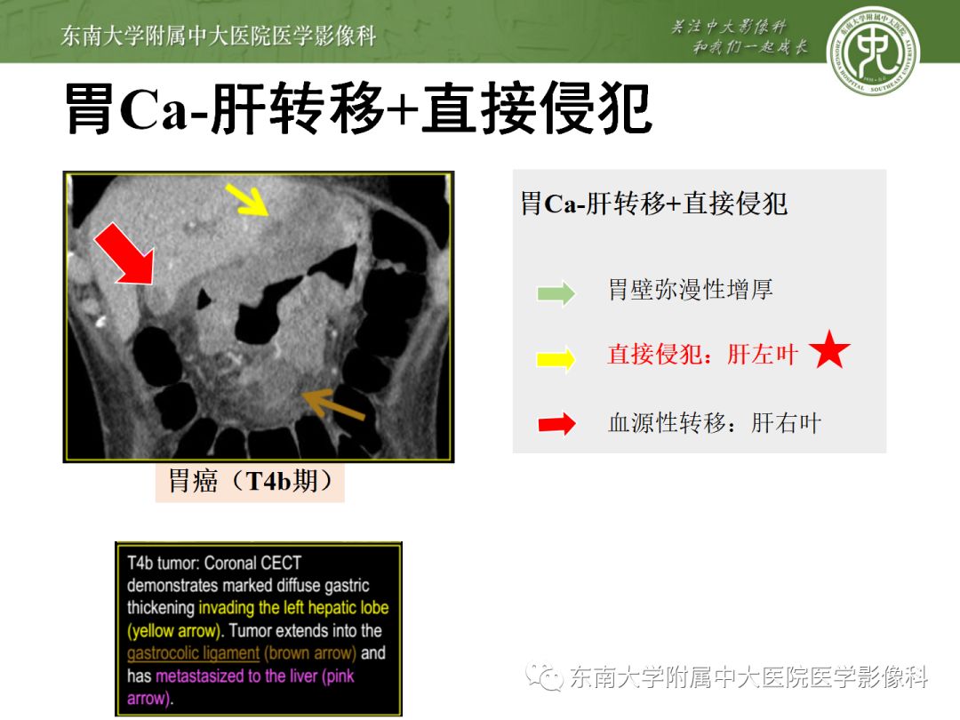 影像PPT - 【病例】胃肝样腺癌伴肝转移2例影像诊断-20