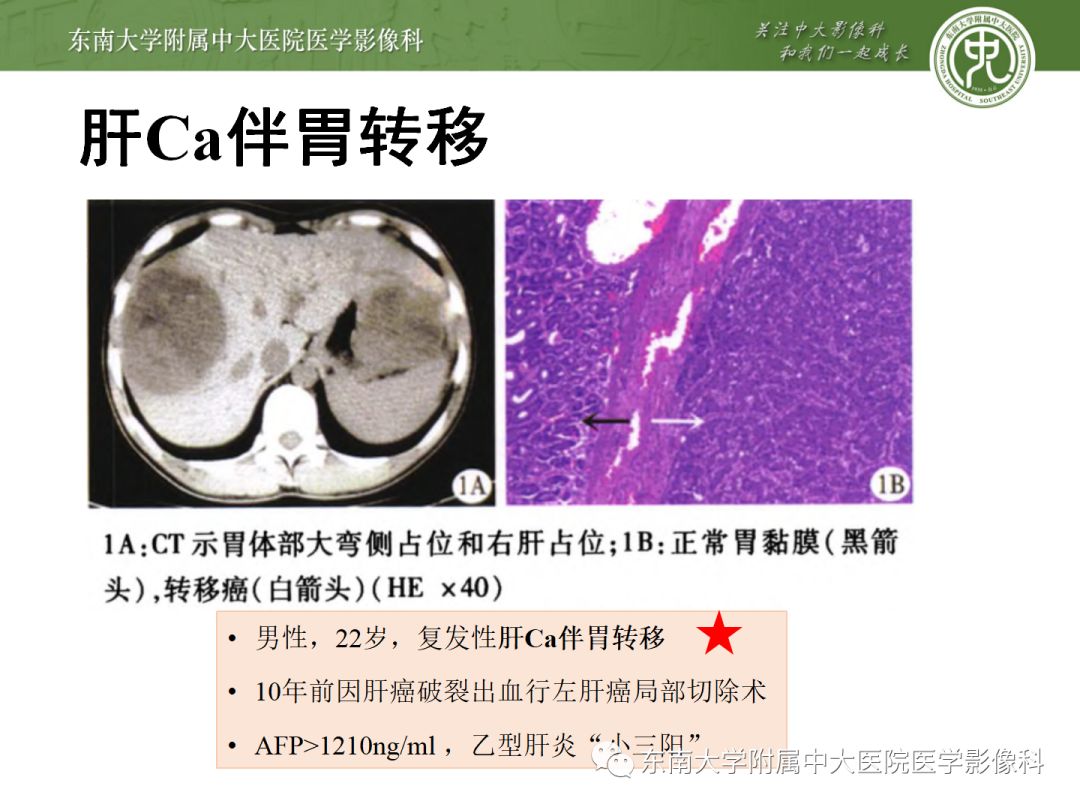 影像PPT - 【病例】胃肝样腺癌伴肝转移2例影像诊断-22