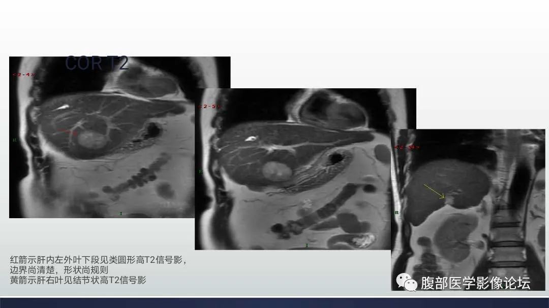 影像PPT - 【病例】肝细胞肝癌2例CT及MR影像-5 影像PPT - 【病例】肝细胞肝癌2例CT及MR影像-5