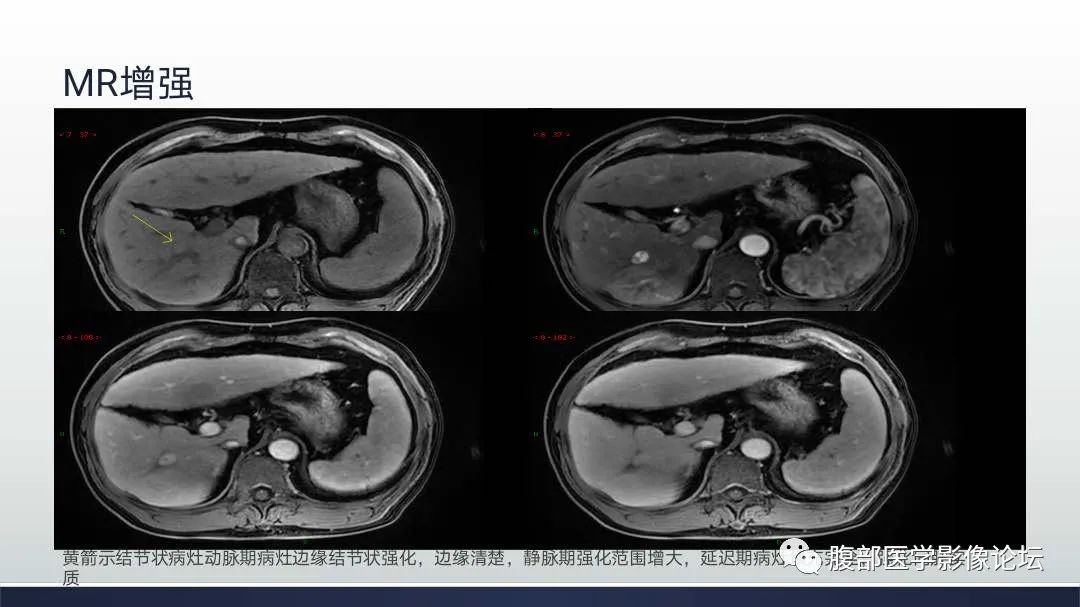 影像PPT - 【病例】肝细胞肝癌2例CT及MR影像-9 影像PPT - 【病例】肝细胞肝癌2例CT及MR影像-9