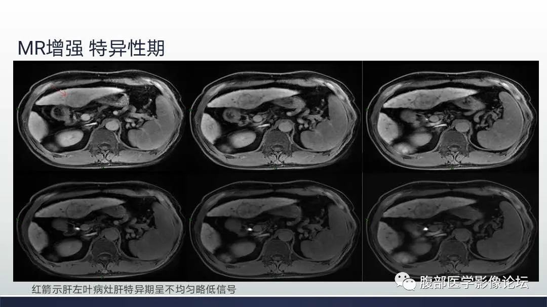 影像PPT - 【病例】肝细胞肝癌2例CT及MR影像-11 影像PPT - 【病例】肝细胞肝癌2例CT及MR影像-11