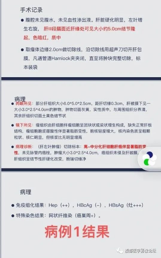 影像PPT - 【病例】肝细胞肝癌2例CT及MR影像-13 影像PPT - 【病例】肝细胞肝癌2例CT及MR影像-13