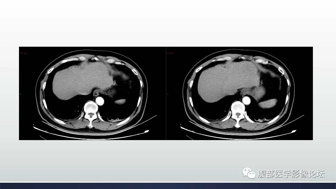 影像PPT - 【病例】肝细胞肝癌2例CT及MR影像-20 影像PPT - 【病例】肝细胞肝癌2例CT及MR影像-20