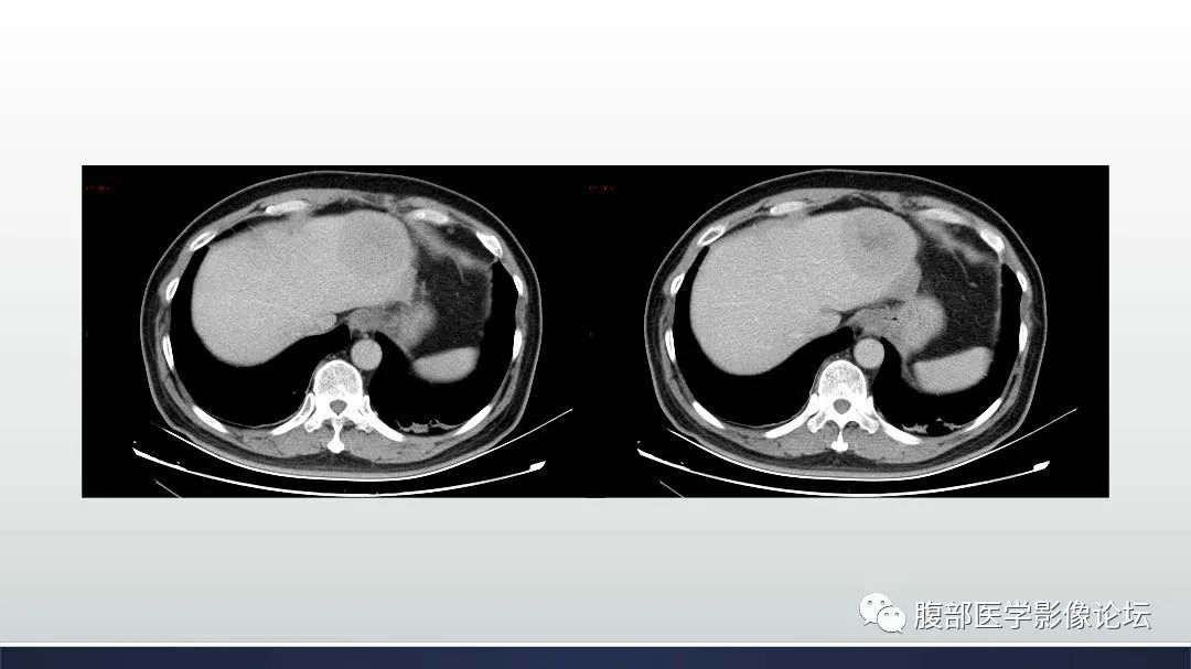 影像PPT - 【病例】肝细胞肝癌2例CT及MR影像-25 影像PPT - 【病例】肝细胞肝癌2例CT及MR影像-25