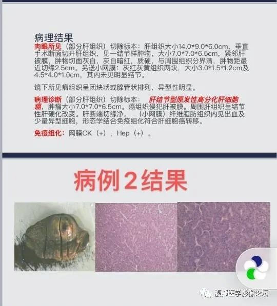 影像PPT - 【病例】肝细胞肝癌2例CT及MR影像-30 影像PPT - 【病例】肝细胞肝癌2例CT及MR影像-30