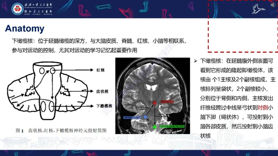 影像PPT - 【PPT】肥大性下橄榄核变性MRI诊断-6