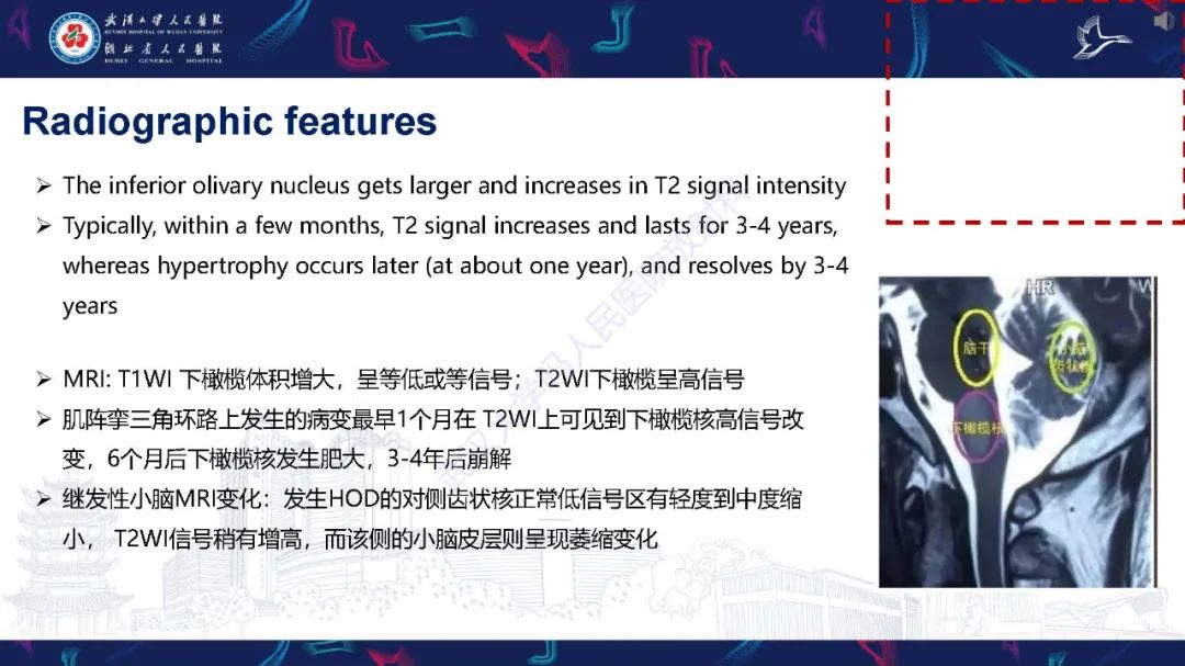 影像PPT - 【PPT】肥大性下橄榄核变性MRI诊断-13