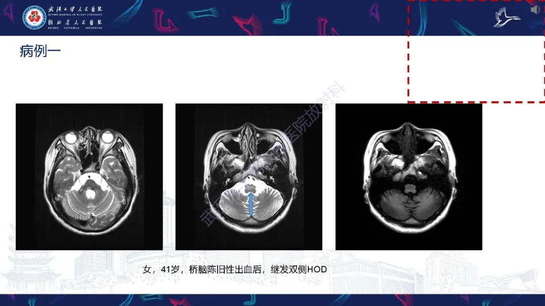 影像PPT - 【PPT】肥大性下橄榄核变性MRI诊断-14