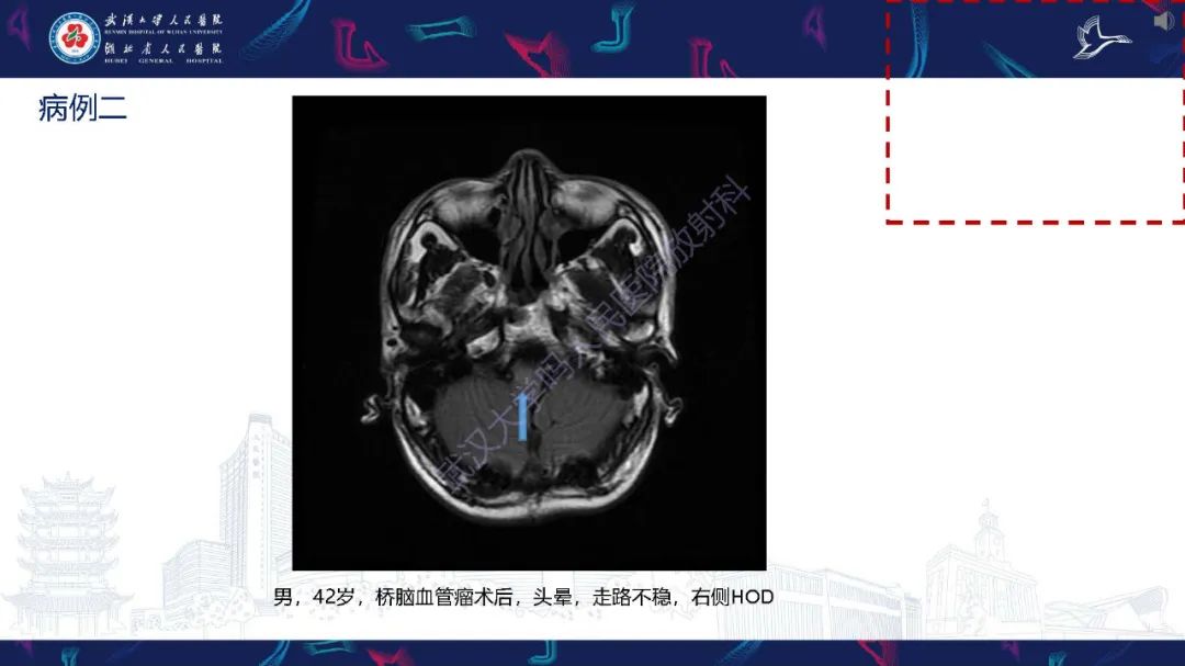 影像PPT - 【PPT】肥大性下橄榄核变性MRI诊断-15