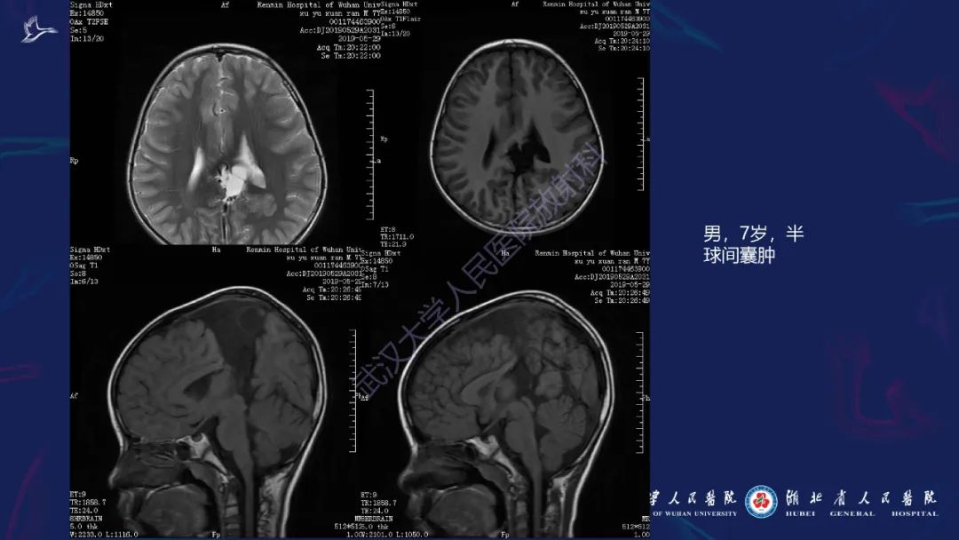 影像PPT - 【PPT】胼胝体病变影像诊断-12