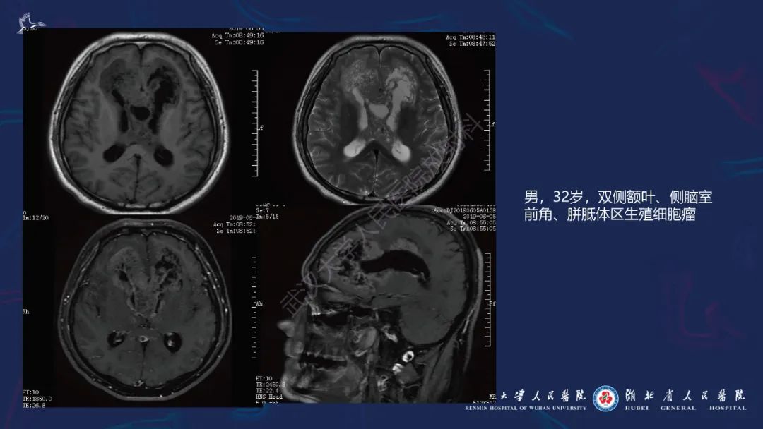 影像PPT - 【PPT】胼胝体病变影像诊断-42