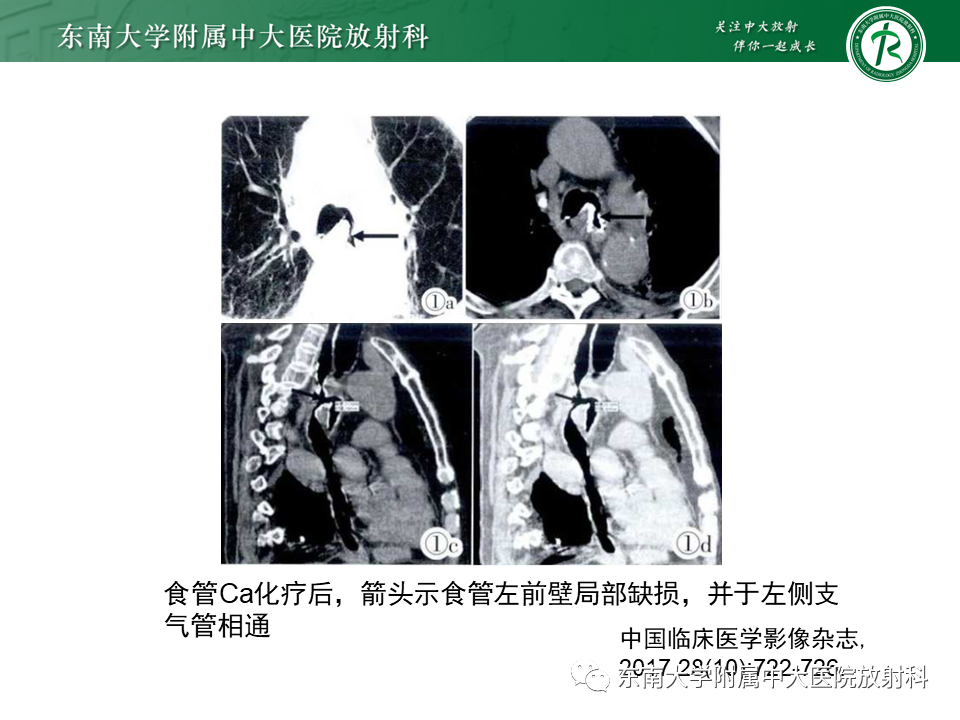 影像PPT - 【病例】食管-气管瘘1例CT影像-13