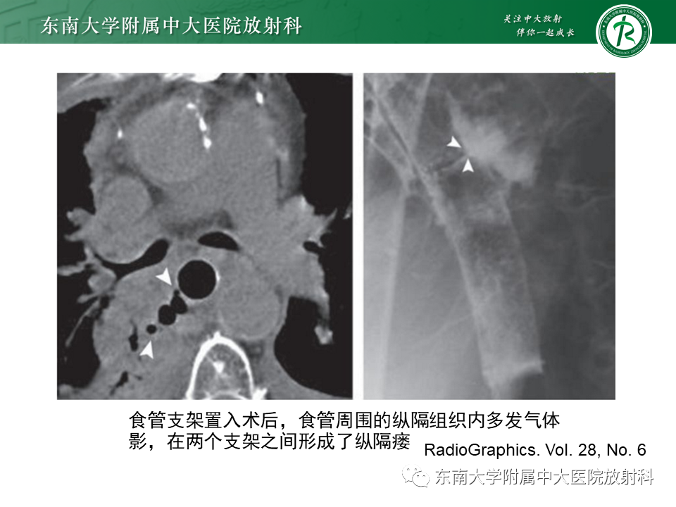 影像PPT - 【病例】食管-气管瘘1例CT影像-15