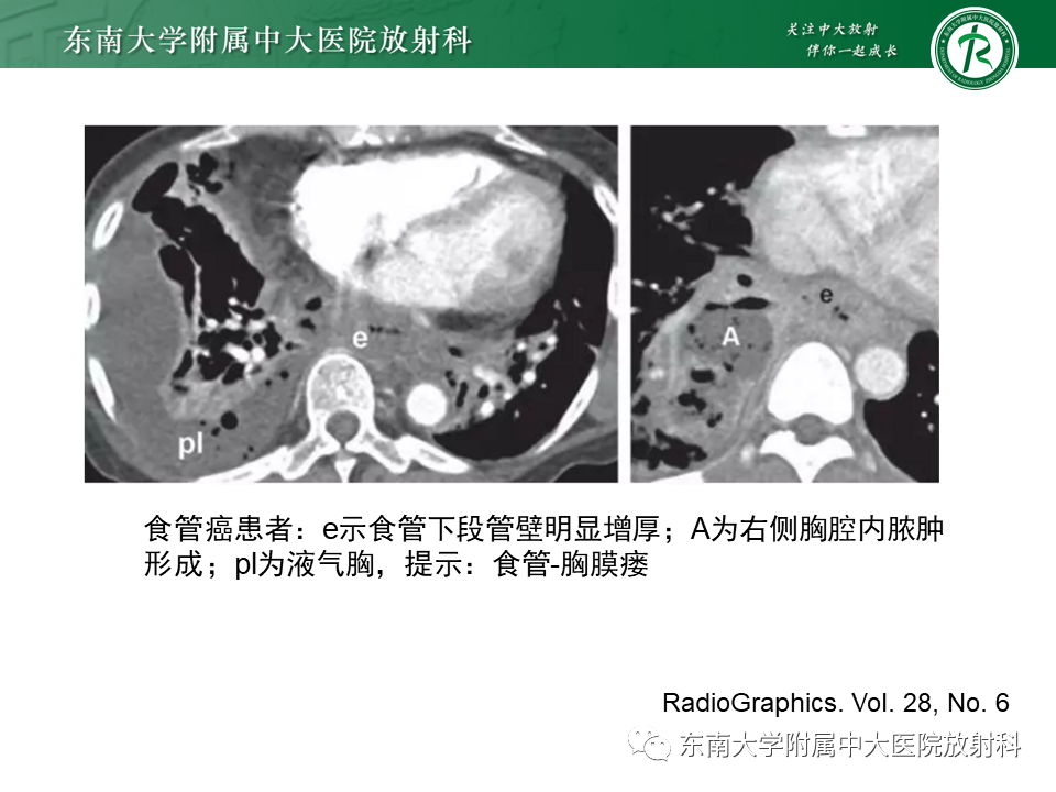 影像PPT - 【病例】食管-气管瘘1例CT影像-18