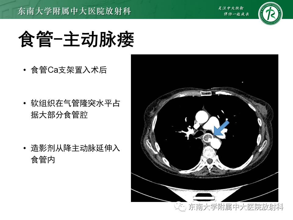 影像PPT - 【病例】食管-气管瘘1例CT影像-20