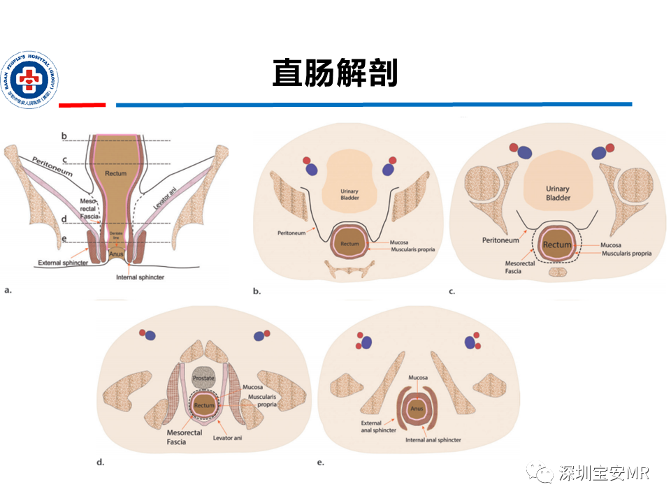 影像PPT - 【PPT】直肠癌MRI影像评估-4