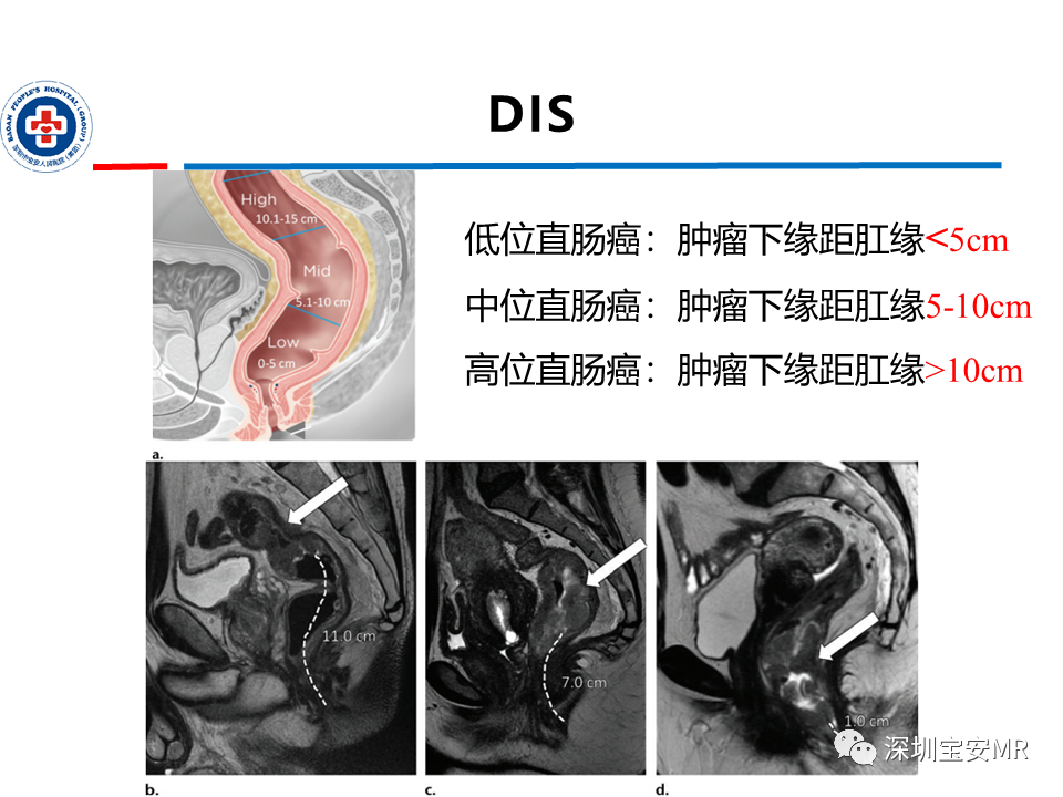 影像PPT - 【PPT】直肠癌MRI影像评估-7