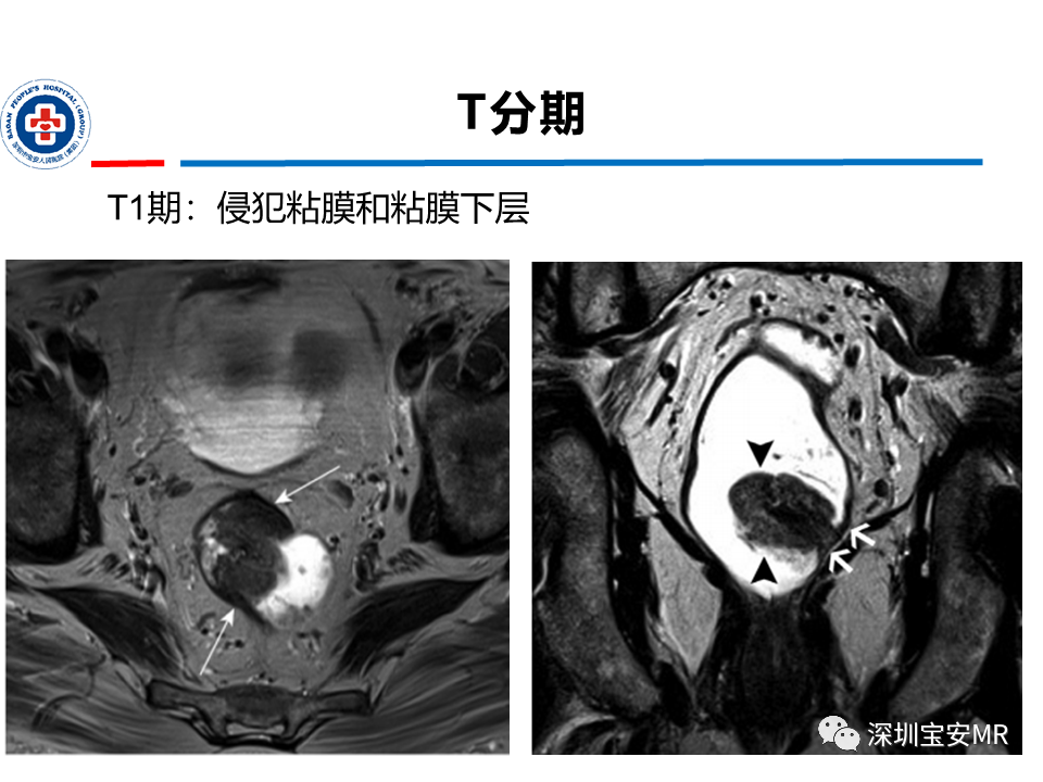 影像PPT - 【PPT】直肠癌MRI影像评估-11