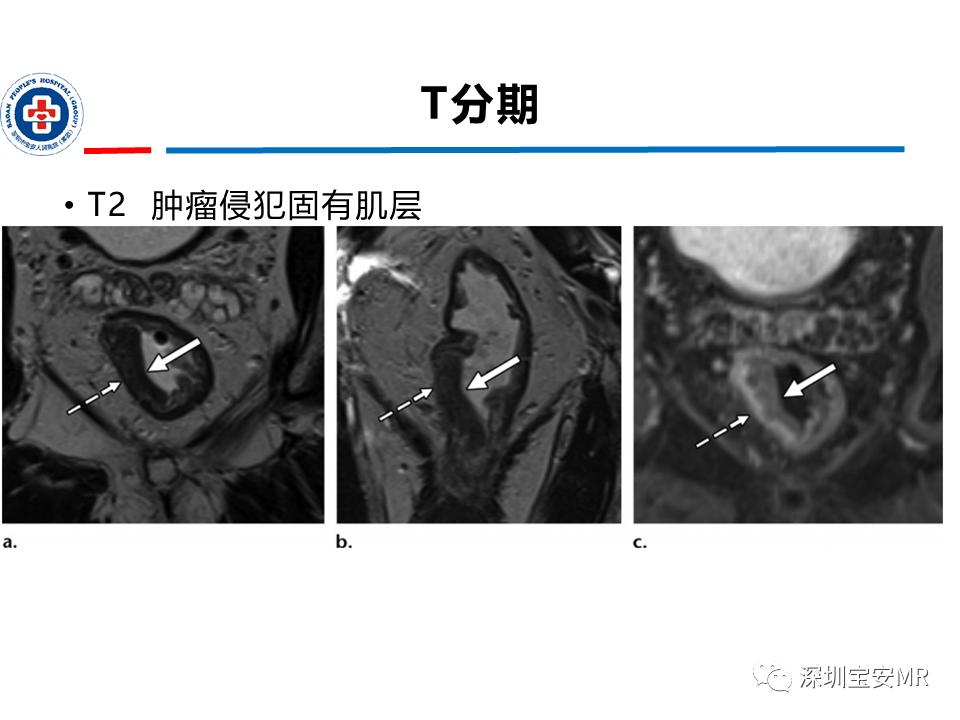 影像PPT - 【PPT】直肠癌MRI影像评估-13