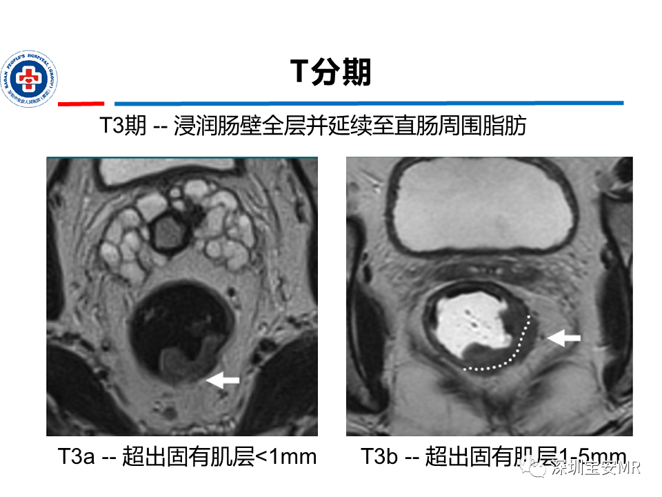 影像PPT - 【PPT】直肠癌MRI影像评估-16