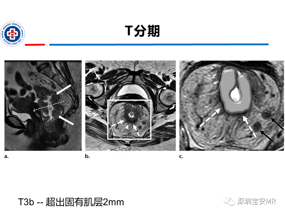 影像PPT - 【PPT】直肠癌MRI影像评估-18