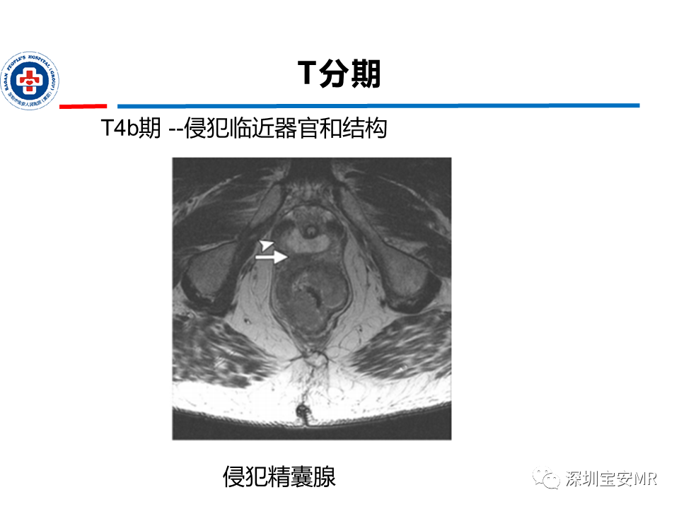 影像PPT - 【PPT】直肠癌MRI影像评估-20