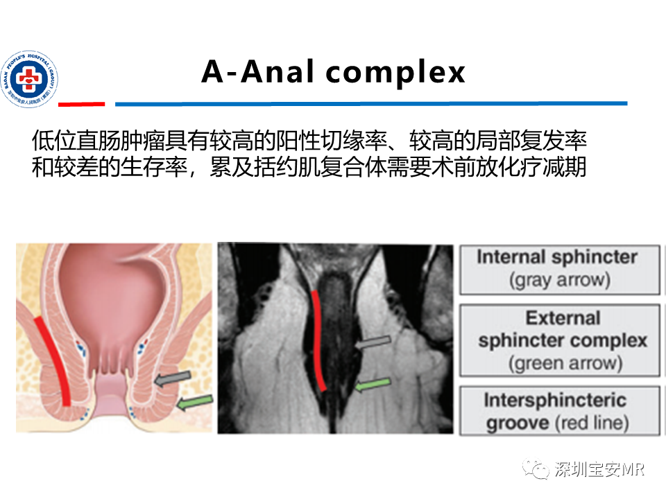 影像PPT - 【PPT】直肠癌MRI影像评估-26
