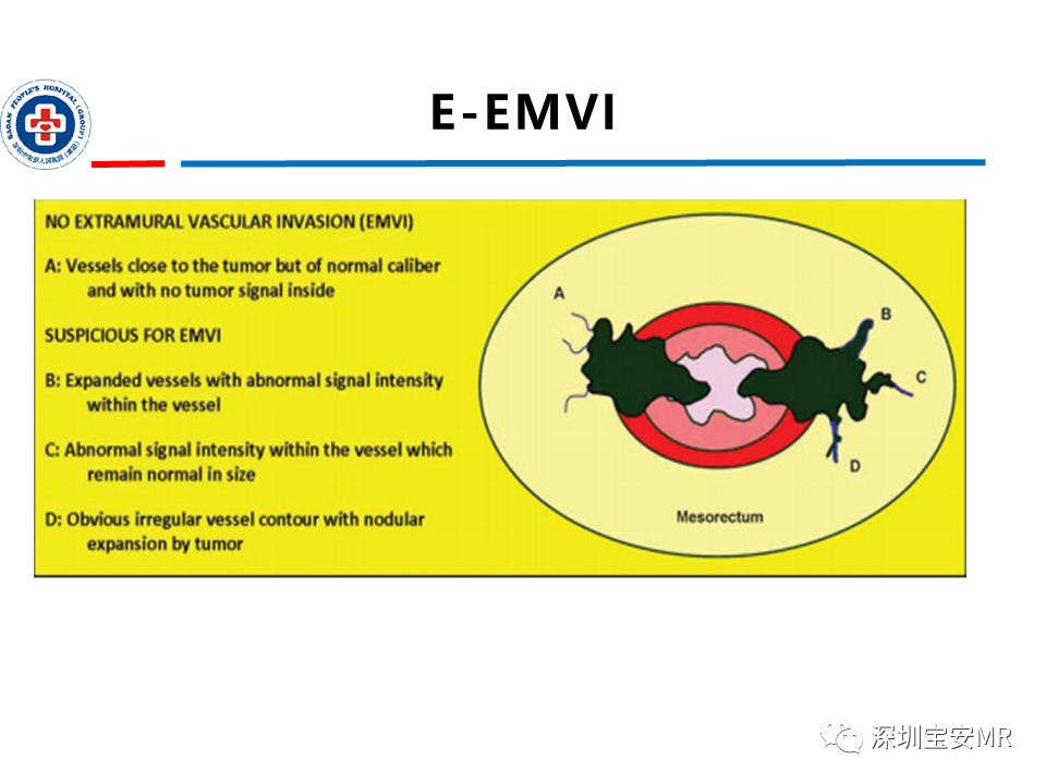 影像PPT - 【PPT】直肠癌MRI影像评估-41