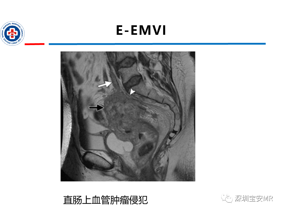 影像PPT - 【PPT】直肠癌MRI影像评估-43