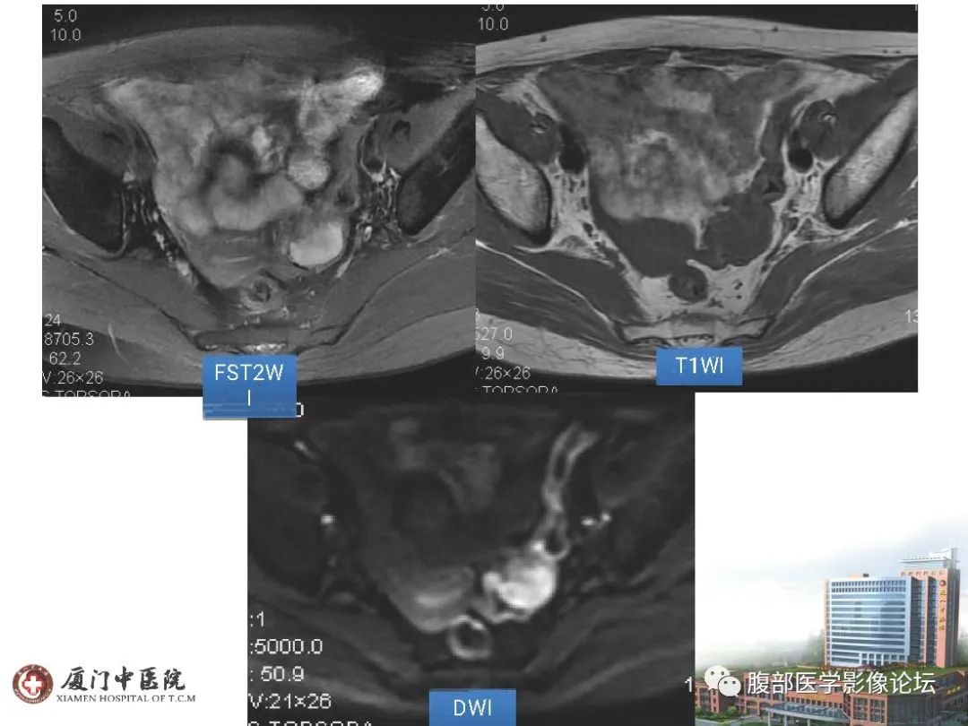 影像PPT - 【病例】直肠炎性肌纤维⺟细胞瘤1例MR影像-3 影像PPT - 【病例】直肠炎性肌纤维⺟细胞瘤1例MR影像-3