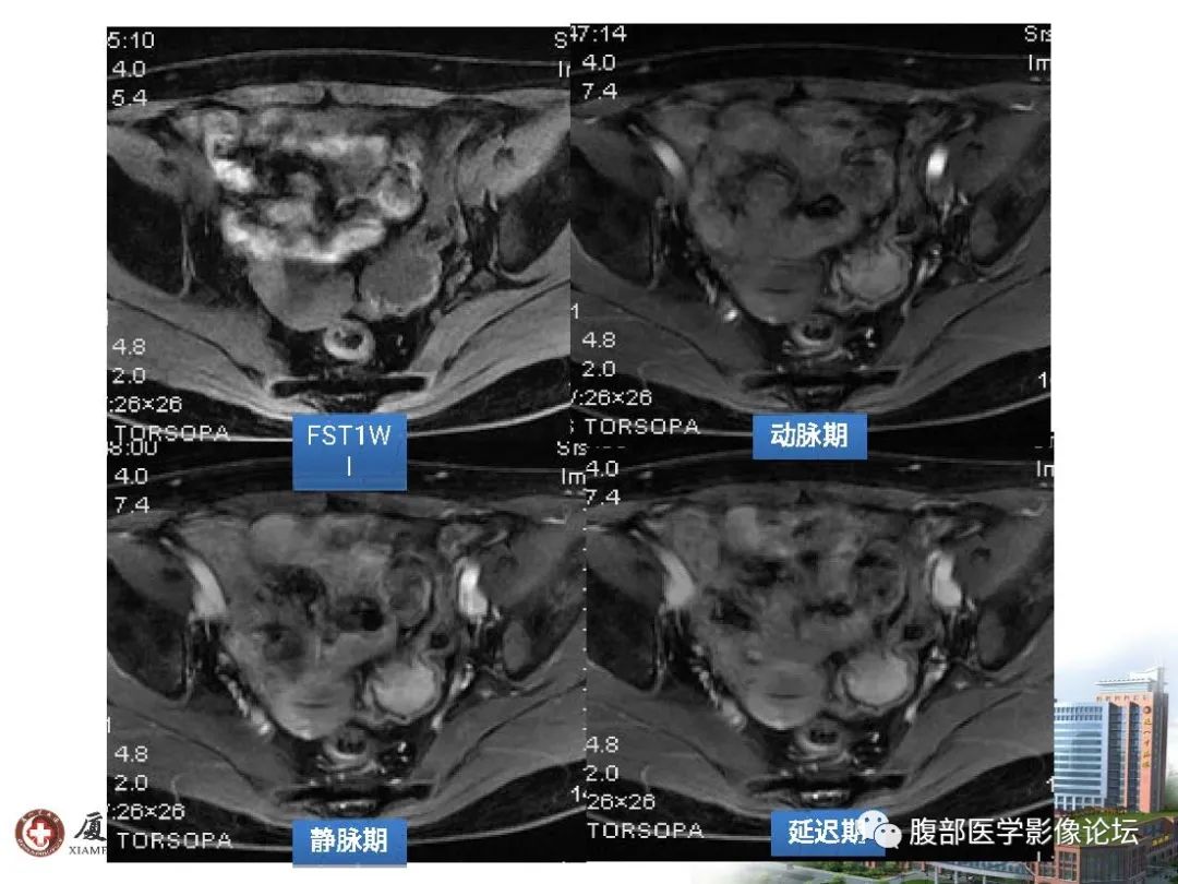 影像PPT - 【病例】直肠炎性肌纤维⺟细胞瘤1例MR影像-4 影像PPT - 【病例】直肠炎性肌纤维⺟细胞瘤1例MR影像-4