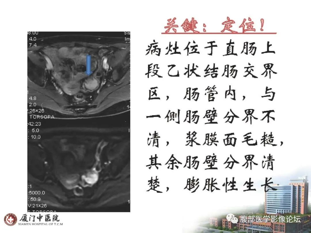 影像PPT - 【病例】直肠炎性肌纤维⺟细胞瘤1例MR影像-7 影像PPT - 【病例】直肠炎性肌纤维⺟细胞瘤1例MR影像-7