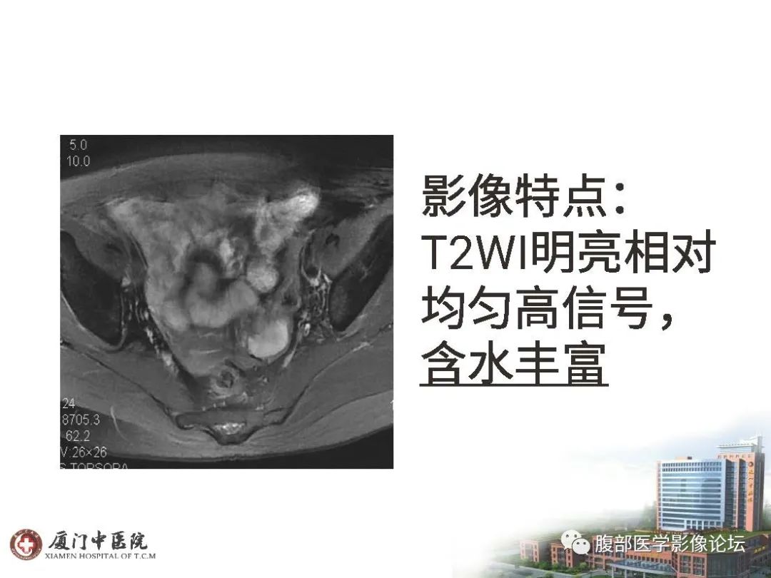 影像PPT - 【病例】直肠炎性肌纤维⺟细胞瘤1例MR影像-8 影像PPT - 【病例】直肠炎性肌纤维⺟细胞瘤1例MR影像-8