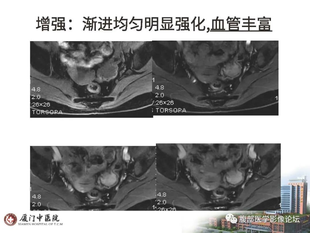 影像PPT - 【病例】直肠炎性肌纤维⺟细胞瘤1例MR影像-9 影像PPT - 【病例】直肠炎性肌纤维⺟细胞瘤1例MR影像-9