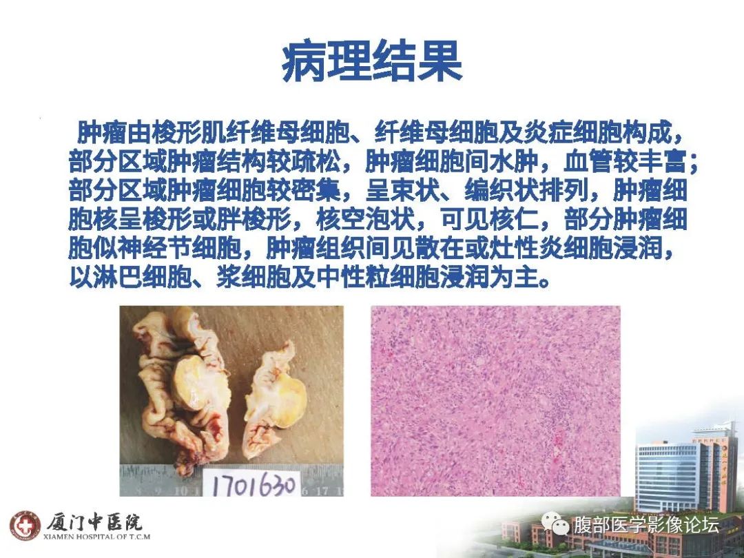 影像PPT - 【病例】直肠炎性肌纤维⺟细胞瘤1例MR影像-11 影像PPT - 【病例】直肠炎性肌纤维⺟细胞瘤1例MR影像-11