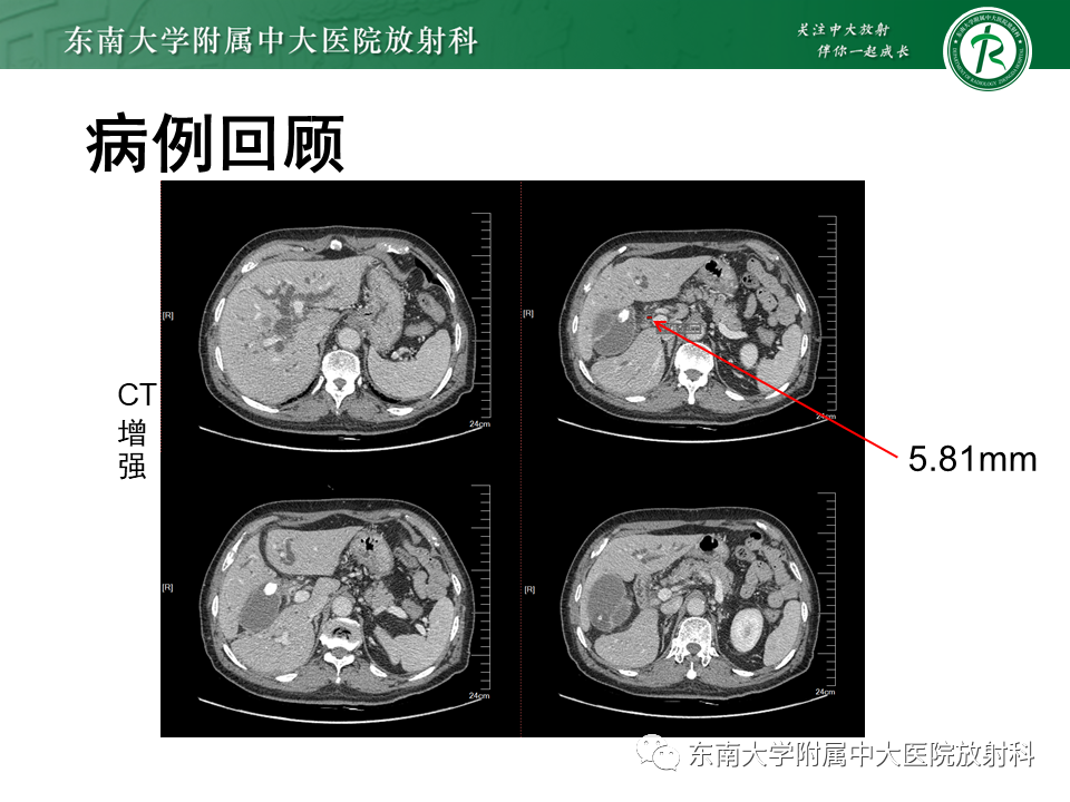 影像PPT - 【PPT】恶性胆道梗阻疾病影像诊断思路-2