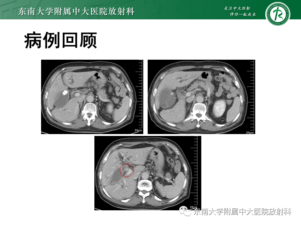 影像PPT - 【PPT】恶性胆道梗阻疾病影像诊断思路-3