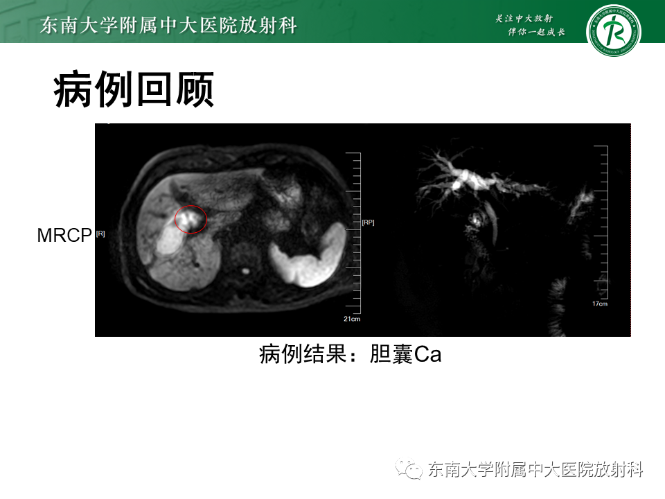 影像PPT - 【PPT】恶性胆道梗阻疾病影像诊断思路-4