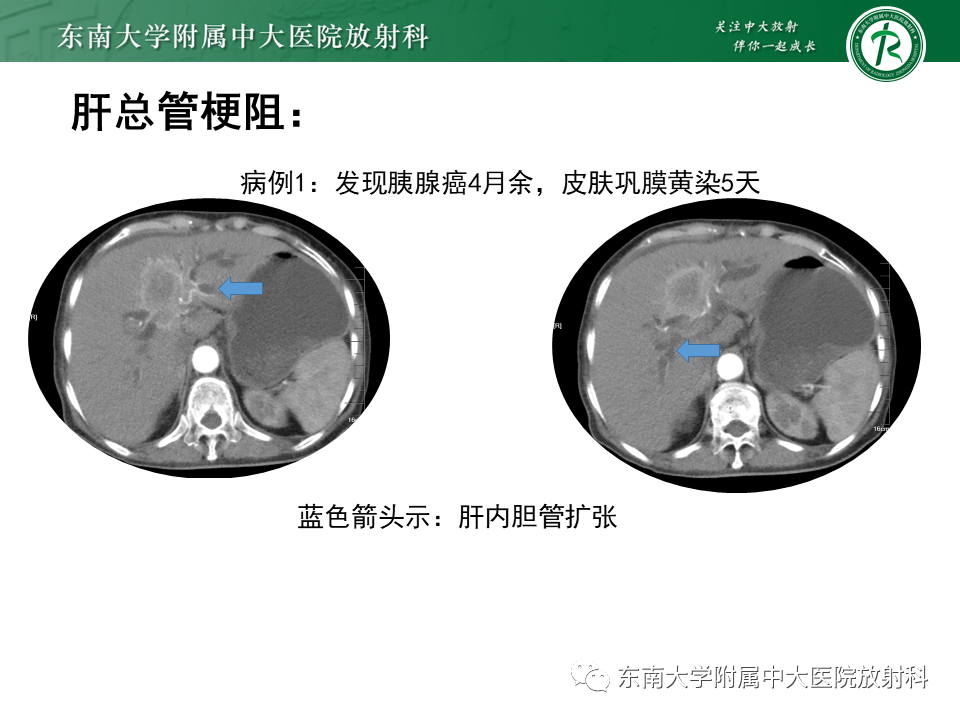 影像PPT - 【PPT】恶性胆道梗阻疾病影像诊断思路-12