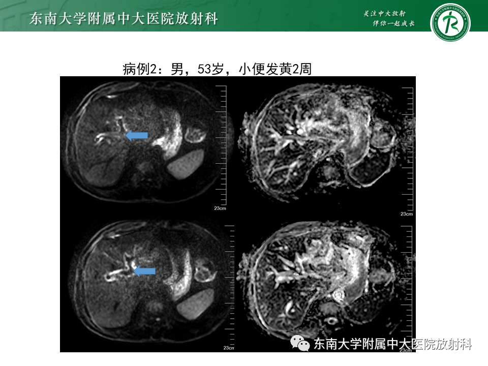 影像PPT - 【PPT】恶性胆道梗阻疾病影像诊断思路-13