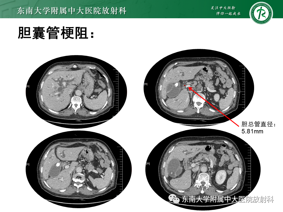 影像PPT - 【PPT】恶性胆道梗阻疾病影像诊断思路-19